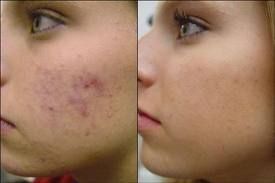 Tratamento do kit anti acne
